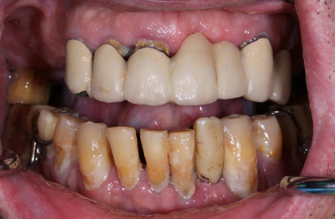 Arcadă dentară înainte de reconstrucție, cu restaurări vechi și uzură vizibilă