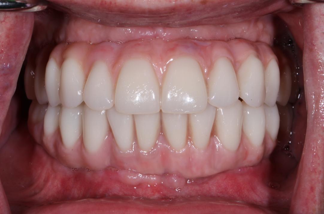 Arcadă dentară după reconstrucție, cu dinți aliniați și o nuanță naturală