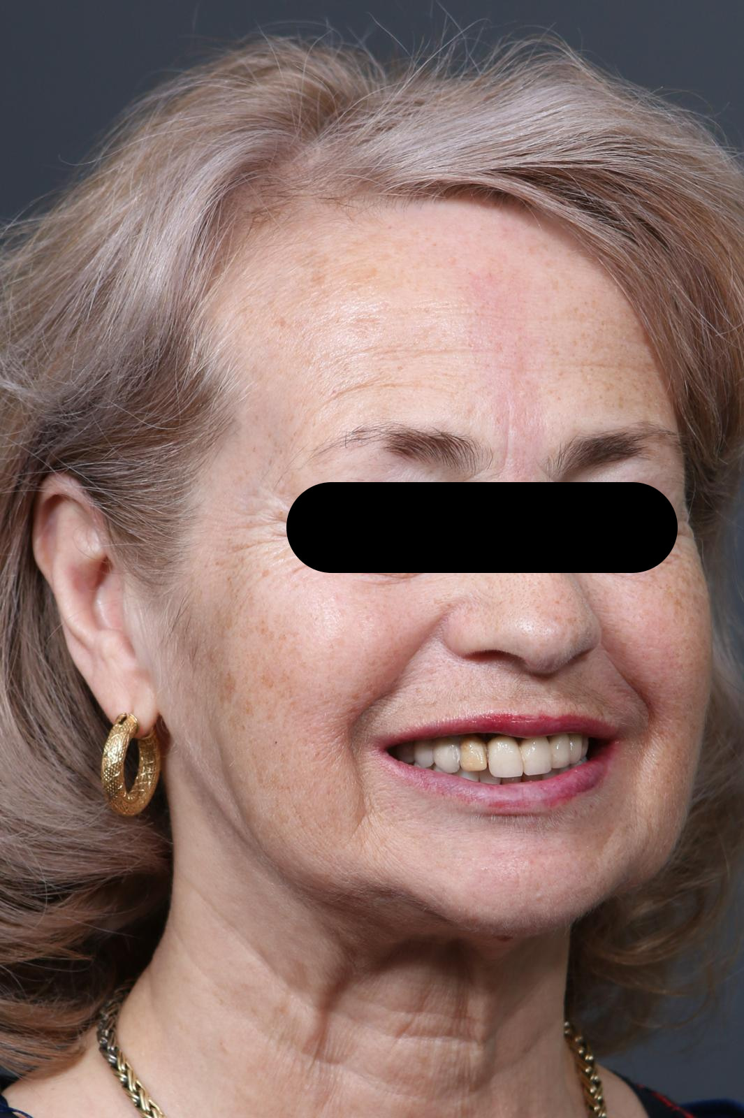 Zâmbet din trei sferturi înainte de tratamentul estetic la Clinica Dentissimi