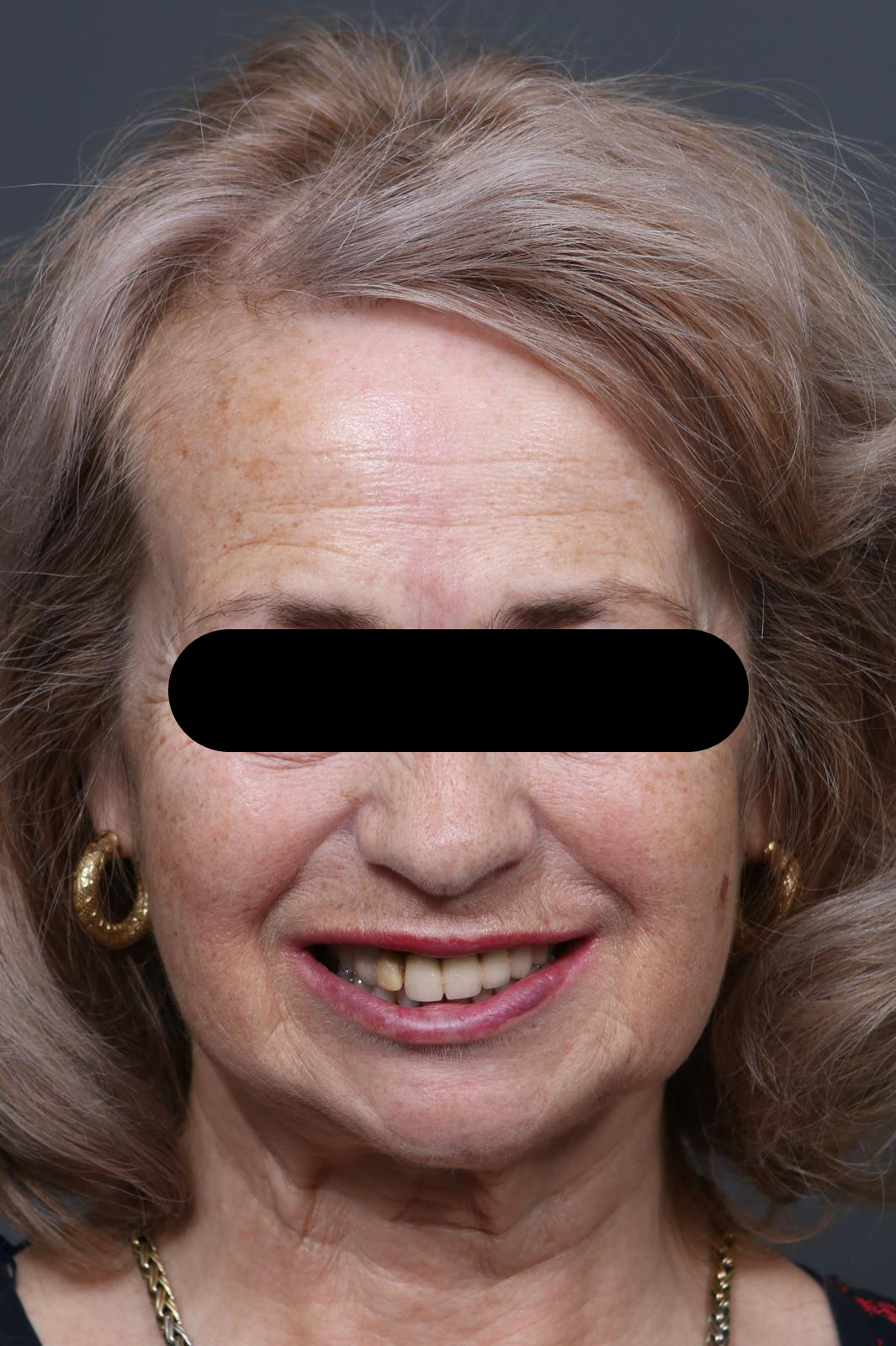 Zâmbet frontal înainte de tratamentul estetic la Clinica Dentissimi